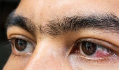 आईफ्लू से बचाव के लिए रखे विशेष सावधानी— चिकित्सा विभाग ने सभी सीएमएचओ एवं पीएमओ को जारी किये दिशा-निर्देश